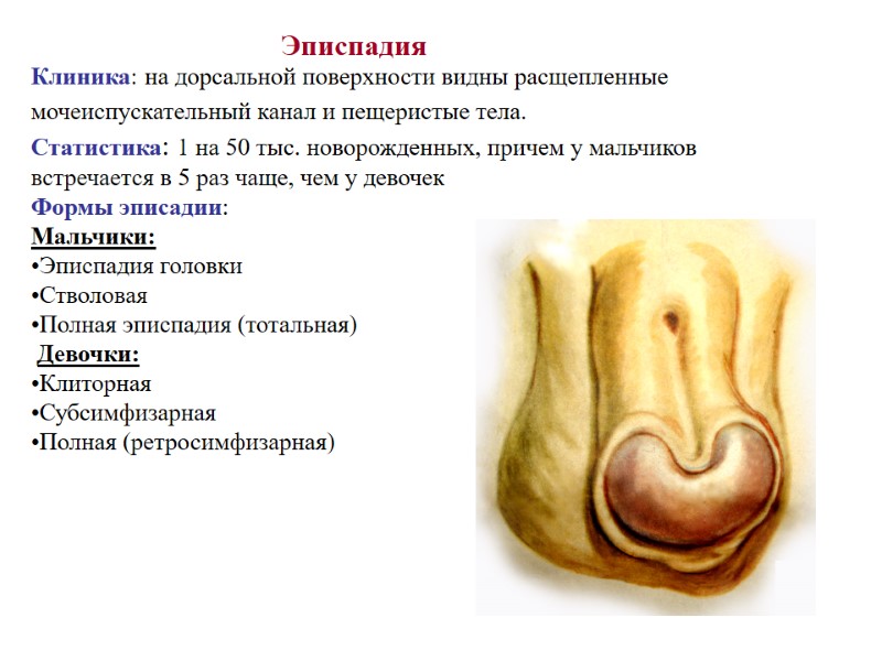 Эписпадия Клиника: на дорсальной поверхности видны расщепленные  мочеиспускательный канал и пещеристые тела. 